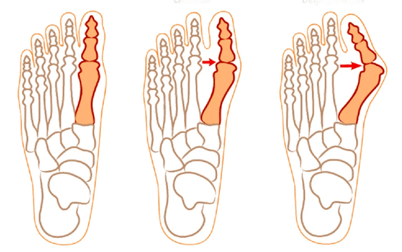 Hallux valgus misvorming
