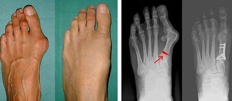 symptomen van hallux valgus