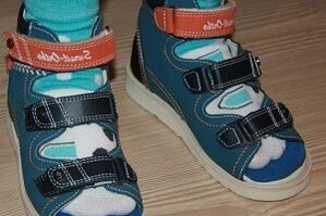 het dragen van sandalen voor hallux valgus bij een kind