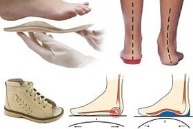 orthopedische schoenen voor hallux valgus bij een kind