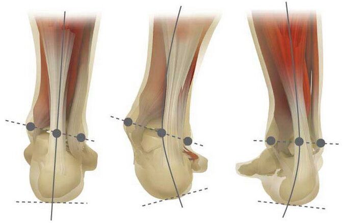 Soorten Valgus