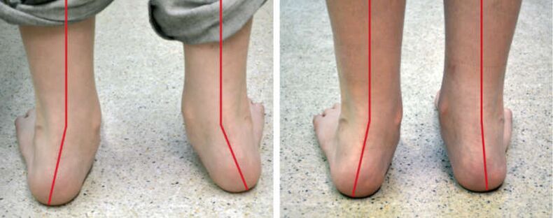 Valgus -benen