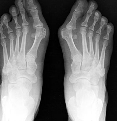 X -ray van de voet